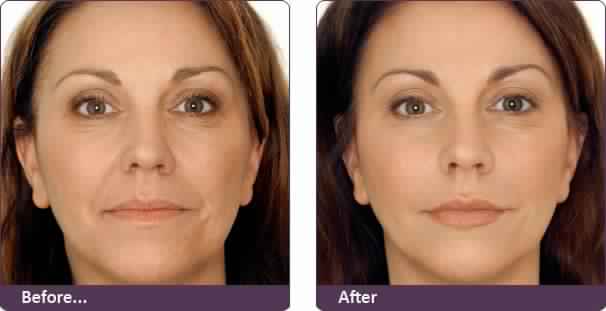 Botox for Drooping Smile