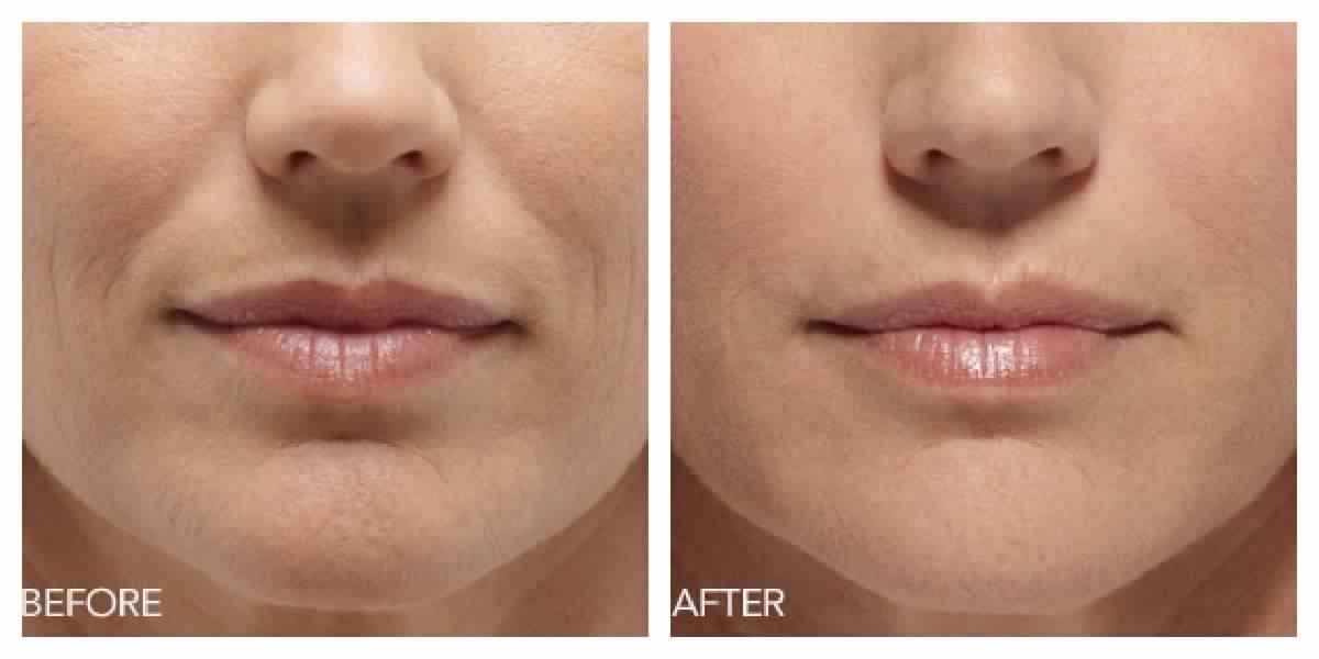 Botox for Lip Lines or Wrinkles